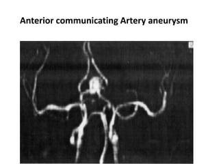 Anterior communicating Artery aneurysm
 