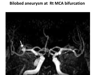 Bilobed aneurysm at Rt MCA bifurcation
 