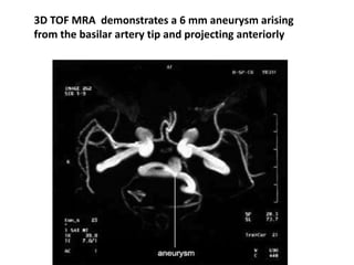 3D TOF MRA demonstrates a 6 mm aneurysm arising
from the basilar artery tip and projecting anteriorly
 