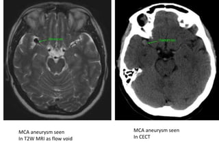 MCA aneurysm seen
In T2W MRI as flow void
MCA aneurysm seen
In CECT
 