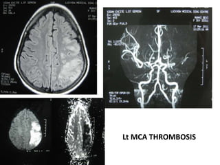 Lt MCA THROMBOSIS
 