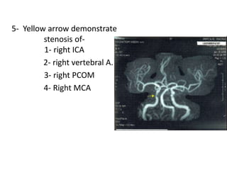 5- Yellow arrow demonstrate
stenosis of-
1- right ICA
2- right vertebral A.
3- right PCOM
4- Right MCA
 