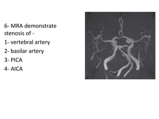 6- MRA demonstrate
stenosis of -
1- vertebral artery
2- basilar artery
3- PICA
4- AICA
 