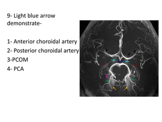 9- Light blue arrow
demonstrate-
1- Anterior choroidal artery
2- Posterior choroidal artery
3-PCOM
4- PCA
 