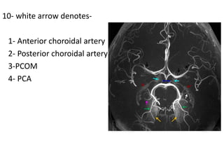10- white arrow denotes-
1- Anterior choroidal artery
2- Posterior choroidal artery
3-PCOM
4- PCA
 