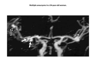Multiple aneurysms in a 54-year-old woman.
 