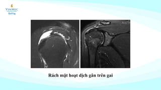 Rách mặt hoạt dịch gân trên gai
 