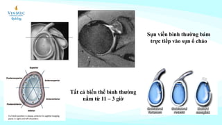 Sụn viền bình thường bám
trực tiếp vào sụn ổ chảo
Tất cả biến thể bình thường
nằm từ 11 – 3 giờ
 