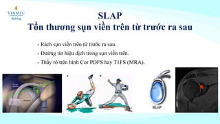 - Rách sụn viền trên từ trước ra sau.
- Đường tín hiệu dịch trong sụn viền trên.
- Thấy rõ trên hình Cor PDFS hay T1FS (MRA).
SLAP
Tổn thương sụn viền trên từ trước ra sau
 