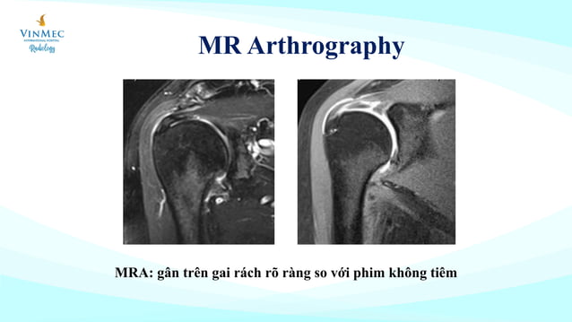 MR arthrography khớp vai | PDF