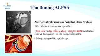 Anterior Labroligamentous Periosteal Sleeve Avulsion
Biến thể của tt Bankart với đặc điểm:
• Sụn viền và dây chằng ổ chảo - cánh tay dưới tách khỏi ổ
chảo và di chuyển vị trí vào trong, xuống dưới.
• Màng xương ổ chảo nguyên vẹn.
Tổn thương ALPSA
 