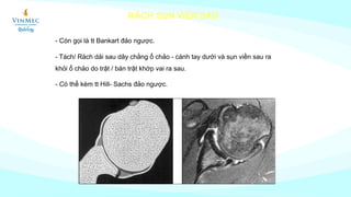 RÁCH SỤN VIỀN SAU
- Còn gọi là tt Bankart đảo ngược.
- Tách/ Rách dải sau dây chằng ổ chảo - cánh tay dưới và sụn viền sau ra
khỏi ổ chảo do trật / bán trật khớp vai ra sau.
- Có thể kèm tt Hill- Sachs đảo ngược.
 