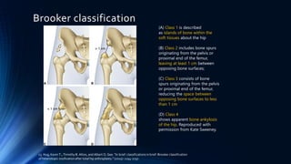 MRI post hip arthroplasty | PDF