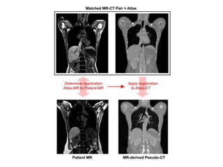 Mr based attenuation correction in pet | PPTX