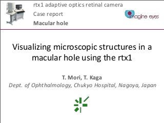 rtx1 adaptive optics retinal camera 
Case report 
Macular hole 
Visualizing microscopic structures in a 
macular hole using the rtx1 
T. Mori, T. Kaga 
Dept. of Ophthalmology, Chukyo Hospital, Nagoya, Japan 
 