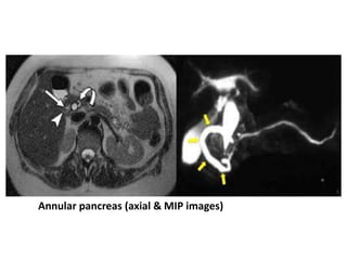 Annular pancreas (axial & MIP images)
 