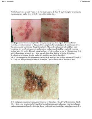 Antibiotics are not useful. Throat swab for streptococcus & chest X-ray looking for mycoplasma
pneumoniae are useful steps in the Rx but not the initial steps.
24. Herpes zoster occurs in people who have previously had chickenpox. The virus Herpes
varicella-zoster lies dormant in the dorsal root ganglion after chicken pox, & later travels down
the cutaneous nerves to infect the epidermal cells. The prodromal period is fol↓ed by a rash
consisting of a gp of vesicles on an erythematous background, fol↓ed by weeping & crusting;
healing takes 3-4 weeks. The rash is nearly always U/L & confined to one or 2 dermatomes. Oral
antiviral agents ex. aciclovir at a ↑ dose are only beneficial if given in the 1st 48 h of the
development of blisters. Regular analgesics are important, but in the elderly
esp. if given as soon as the rash appears, prophylactic amitriptyline at night starting at 25 mg & ↑
to 75 mg can help prevent post-herpetic neuralgia. Topical aciclovir is of no benefit at all.
25.A malignant melanoma is a malignant tumour of the melanocytes. 2/3 a↑ from normal skin &
1/3 a↑ from a pre-existing mole. Superficial spreading malignant melanomas occur as malignant
melanocytes migrate laterally along the derma-epidermal junction, & have a good prognosis. It is
MRCP2 Dermatology Dr.Sherif Badrawy
 