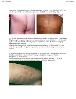 important to diagnose melanomas while they are thin so removal ➜cure. Pigmented BCCs are
heavily pigmented lesions but have the appearance of a BCC -nodules é rolling edges.
26.This lady has tinea corporis. This is dt dermatophyte fungi of the Microsporum, Trichophyton
& Epidermophyton species. It presents é an asymmetrical erythema & itching é a well· defined
edge. It is very important to obtain mycological confirmation of the Dx from skin scrapings
before starting Rx. Since the
infection of dermatophytes is in the keratin layer on the surface of the skin, topical Rx works
better than systemic Rx. Fungicidal drugs ex. terbinafine or imidazoles (e.g. itraconazole) are
effective.
27.Most women who c/o of flushing do suspect the menopause, but it is important to remember
the other causes. Pts c/o of assoc. Sx of sweating waking them at night are likely to be
menopausal. Sx of anxiety and
hyperthyroidism (another common cause of flushing) can often be confused. CCBs are a
common cause of facial flushing, which can often be continuous & persistent.
MRCP2 Dermatology Dr.Sherif Badrawy
 