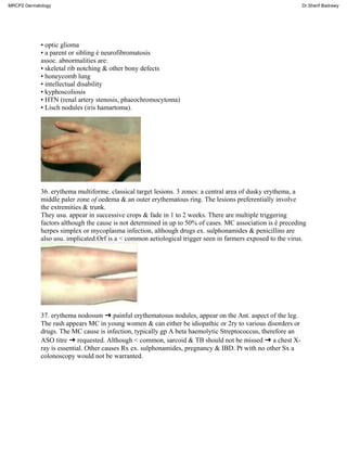 • optic glioma
• a parent or sibling é neurofibromatosis
assoc. abnormalities are:
• skeletal rib notching & other bony defects
• honeycomb lung
• intellectual disability
• kyphoscoliosis
• HTN (renal artery stenosis, phaeochromocytoma)
• Lisch nodules (iris hamartoma).
36. erythema multiforme. classical target lesions. 3 zones: a central area of dusky erythema, a
middle paler zone of oedema & an outer erythematous ring. The lesions preferentially involve
the extremities & trunk.
They usu. appear in successive crops & fade in 1 to 2 weeks. There are multiple triggering
factors although the cause is not determined in up to 50% of cases. MC association is é preceding
herpes simplex or mycoplasma infection, although drugs ex. sulphonamides & penicillins are
also usu. implicated.Orf is a < common aetiological trigger seen in farmers exposed to the virus.
37. erythema nodosum ➜ painful erythematosus nodules, appear on the Ant. aspect of the leg.
The rash appears MC in young women & can either be idiopathic or 2ry to various disorders or
drugs. The MC cause is infection, typically gp A beta haemolytic Streptococcus, therefore an
ASO titre ➜ requested. Although < common, sarcoid & TB should not be missed ➜ a chest X-
ray is essential. Other causes Rx ex. sulphonamides, pregnancy & IBD. Pt with no other Sx a
colonoscopy would not be warranted.
MRCP2 Dermatology Dr.Sherif Badrawy
 