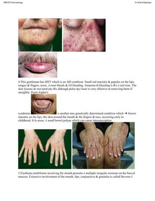 4.This gentleman has HHT which is an AD condition. Small red macules & papules on the lips,
tongue & fingers, assoc. é nose bleeds & GI bleeding. Anaemia dt bleeding is Rx é oral iron. The
skin lesions do not need any Rx although pulse dye laser is very effective at removing them if
unsightly. Peutz.Jegher's
syndrome is another rare genetically determined condition which ➜ brown
macules on the lips, the skin around the mouth & the fingers & toes, occurring early in
childhood. It Is assoc. é small bowel polyps which can cause intussusception.
5.Erythema multiforme involving the mouth presents é multiple irregular erosions on the buccal
mucosa. Extensive involvement of the mouth, lips, conjunctiva & genitalia is called Stevens-J
MRCP2 Dermatology Dr.Sherif Badrawy
 