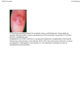 87.This Pt has recurrent cellulitis 2ry to herpetic whit↓, a self-limiting dis. Young adults are
typically affected by HSV-2 where a prodroma up to 72 his fol↓ed by a recurrence of 7-10 days'
duration. Lymphangitis and
lymphadenitis 2ry to HSV infection is a recognised complication. Lymphoedema of the hand &
forearm may rarely develop. Acute infection ➜ Rx with ↑ dose oral aciclovir fol↓ed by ↓er doses
as prophylaxis. Although this is not common it is very important to remember in cases of
unexplained recurrent cellulitis.
MRCP2 Dermatology Dr.Sherif Badrawy
 