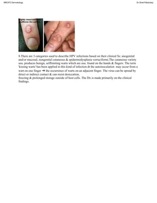 8.There are 3 categories used to describe HPV infections based on their clinical Ss: anogenital
and/or mucosal, nongenital cutaneous & epidermodysplasia verruciformi.The cutaneous variety
usu. produces benign, selflimiting warts which are usu. found on the hands & fingers. The term
'kissing warts' has been applied to this kind of infection dt the autoinoculation may occur from a
wart on one finger ➜ the occurrence of warts on an adjacent finger. The virus can be spread by
direct or indirect contact & can resist desiccation,
freezing & prolonged storage outside of host cells. The Dx is made primarily on the clinical
findings.
MRCP2 Dermatology Dr.Sherif Badrawy
 