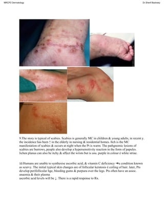 9.The story is typical of scabies. Scabies is generally MC in children & young adults, in recent y.
the incidence has been ↑ in the elderly in nursing & residential homes. Itch is the MC
manifestation of scabies & occurs at night when the Pt is warm. The pathgnomic lesions of
scabies are burrows, people also develop a hypersensitivity reaction in the form of papules.
lichen planus can also be itchy & affect the wrists but is usu. purple in colour é white striae.
10.Humans are unable to synthesise ascorbic acid, & vitamin C deficiency ➜a condition known
as scurvy. The initial typical skin changes are of follicular keratosis é coiling of hair. later, Pts
develop perifollicular hge, bleeding gums & purpura over the legs. Pts often have an assoc.
anaemia & their plasma
ascorbic acid levels will be ↓. There is a rapid response to Rx.
MRCP2 Dermatology Dr.Sherif Badrawy
 