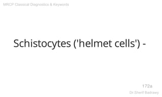 Schistocytes ('helmet cells') -
172a
MRCP Classical Diagnostics & Keywords
Dr.Sherif Badrawy
 