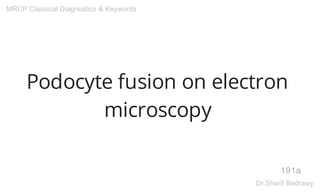 Podocyte fusion on electron
microscopy
191a
MRCP Classical Diagnostics & Keywords
Dr.Sherif Badrawy
 