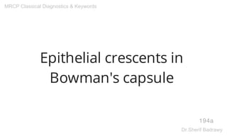Epithelial crescents in
Bowman's capsule
194a
MRCP Classical Diagnostics & Keywords
Dr.Sherif Badrawy
 