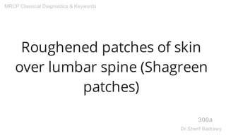 Roughened patches of skin
over lumbar spine (Shagreen
patches)
300a
MRCP Classical Diagnostics & Keywords
Dr.Sherif Badrawy
 
