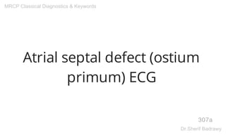 Atrial septal defect (ostium
primum) ECG
307a
MRCP Classical Diagnostics & Keywords
Dr.Sherif Badrawy
 