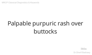 Palpable purpuric rash over
buttocks
360a
MRCP Classical Diagnostics & Keywords
Dr.Sherif Badrawy
 