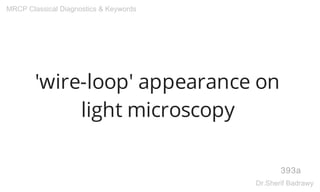 'wire-loop' appearance on
light microscopy
393a
MRCP Classical Diagnostics & Keywords
Dr.Sherif Badrawy
 