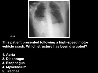 This patient presented following a high-speed motor vehicle crash. Which structure has been disrupted? 1. Aorta 2. Diaphragm 3. Esophagus 4. Myocardium 5. Trachea Q:10 