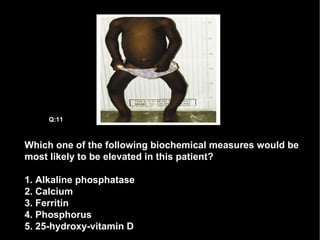 Which one of the following biochemical measures would be most likely to be elevated in this patient? 1. Alkaline phosphatase 2. Calcium 3. Ferritin 4. Phosphorus 5. 25-hydroxy-vitamin D Q:11 