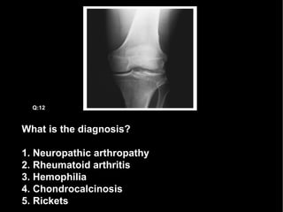 What is the diagnosis? 1. Neuropathic arthropathy 2. Rheumatoid arthritis 3. Hemophilia 4. Chondrocalcinosis 5. Rickets Q:12 