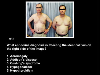 What endocrine diagnosis is affecting the identical twin on the right side of the image? 1. Acromegaly 2. Addison's disease 3. Cushing's syndrome 4. Hypogonadism 5. Hypothyroidism Q:13 