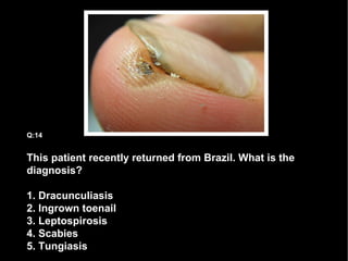 This patient recently returned from Brazil. What is the diagnosis? 1. Dracunculiasis 2. Ingrown toenail 3. Leptospirosis 4. Scabies 5. Tungiasis Q:14 