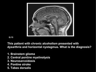 This patient with chronic alcoholism presented with dysarthria and horizontal nystagmus. What is the diagnosis? 1. Brainstem glioma 2. Central pontine myelinolysis 3. Neurosarcoidosis 4. Pontine stroke 5. Tabes dorsalis Q:15 