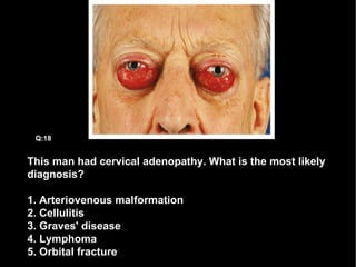 This man had cervical adenopathy. What is the most likely diagnosis? 1. Arteriovenous malformation  2. Cellulitis 3. Graves' disease 4. Lymphoma 5. Orbital fracture Q:18 