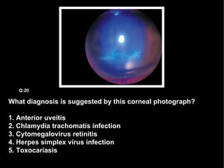 What diagnosis is suggested by this corneal photograph? 1. Anterior uveitis 2. Chlamydia trachomatis infection 3. Cytomegalovirus retinitis 4. Herpes simplex virus infection 5. Toxocariasis Q:20 