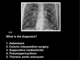 What is the diagnosis? 1. Asbestosis 2. Colonic interposition surgery 3. Suppurative mediastinitis 4. Pneumopericardium 5. Thoracic aortic aneurysm Q:22 
