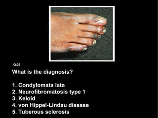 What is the diagnosis? 1. Condylomata lata 2. Neurofibromatosis type 1 3. Keloid 4. von Hippel-Lindau disease 5. Tuberous sclerosis Q:23 