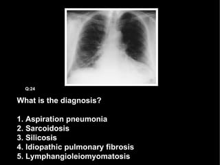 What is the diagnosis? 1. Aspiration pneumonia 2. Sarcoidosis 3. Silicosis 4. Idiopathic pulmonary fibrosis 5. Lymphangioleiomyomatosis Q:24 