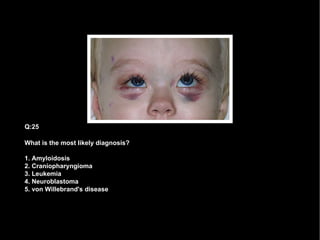 What is the most likely diagnosis? 1. Amyloidosis 2. Craniopharyngioma 3. Leukemia 4. Neuroblastoma 5. von Willebrand's disease Q:25 