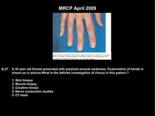 MRCP April 2009 A 30 year old female presented with proximal muscle weakness. Examination of hands is shown as in picture.What is the definite investigation of choice in this patient ? 1. Skin biopsy 2. Muscle biopsy 3. Creatine kinase 4. Nerve conduction studies 5. CT head Q:27 