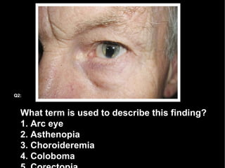 What term is used to describe this finding?  1. Arc eye 2. Asthenopia  3. Choroideremia  4. Coloboma 5. Corectopia Q2: 