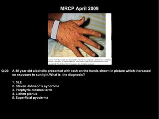 MRCP April 2009 A 40 year old alcoholic presented with rash on the hands shown in picture which increased on exposure to sunlight.What is  the diagnosis? 1. SLE 2. Steven Johnson’s syndrome  3. Porphyria cutanea tarda 4. Lichen planus 5. Superficial pyoderma Q:29 