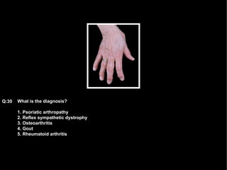 What is the diagnosis? 1. Psoriatic arthropathy 2. Reflex sympathetic dystrophy 3. Osteoarthritis 4. Gout 5. Rheumatoid arthritis Q:30 